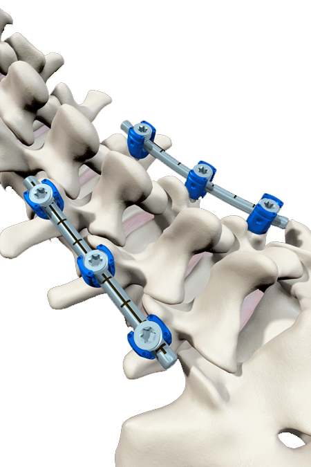 Vital™ Spinal Fixation System